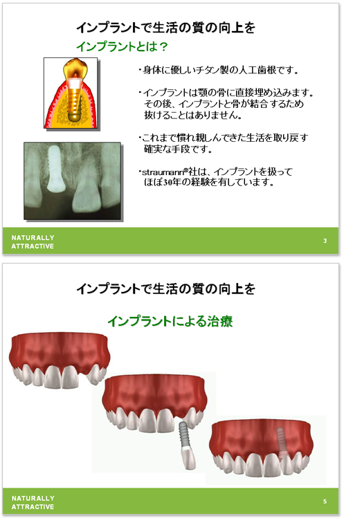 デンタルインプラントとは