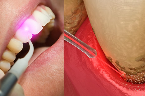 エルビウム・ヤグレーザー
