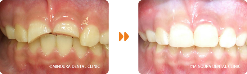 前歯の外傷症例