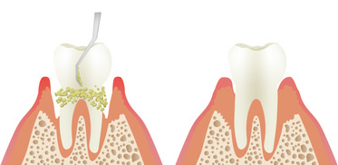 歯石除去
