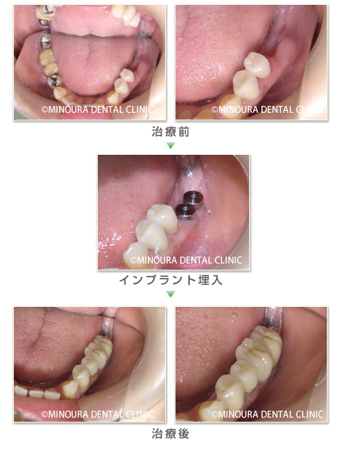 奥歯インプラント症例